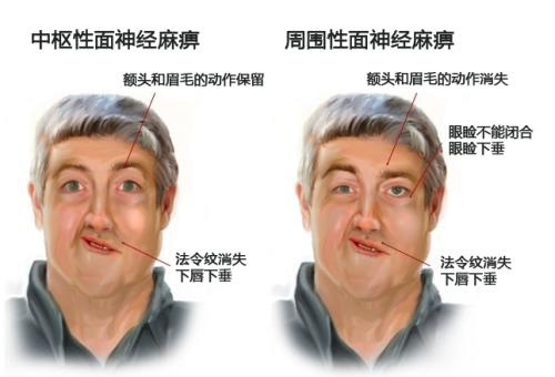 “面癱”不僅不酷，并且需要治療