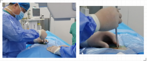 小小“孔鏡”，腰間盤突出患者的福音