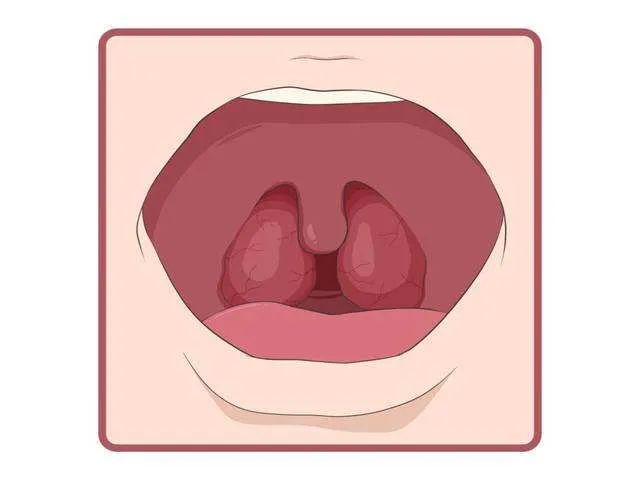 兒童扁桃體肥大需不需要切除？日常護(hù)理要注意