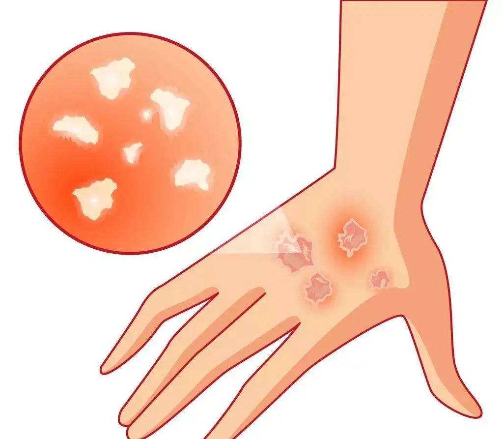 開在皮膚上的“花”？謹防春季玫瑰糠疹