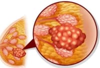 體檢查出結(jié)節(jié)，要切除？關(guān)于結(jié)節(jié)，專家提醒······