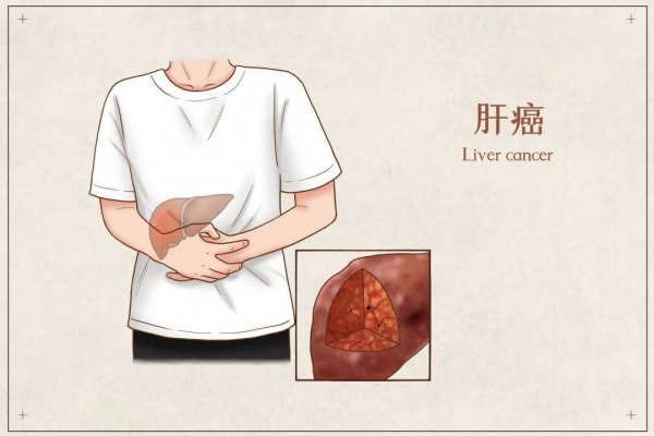 _401794893_banner_肝癌醫(yī)療插畫(非企業(yè)商用).jpg 5-tuya.jpg