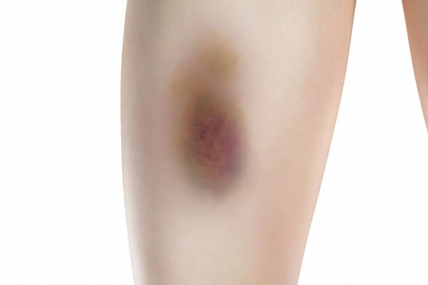 攝圖網(wǎng)_402025788_banner_三維腿部淤青場景(企業(yè)商用).jpg 3-tuya.jpg