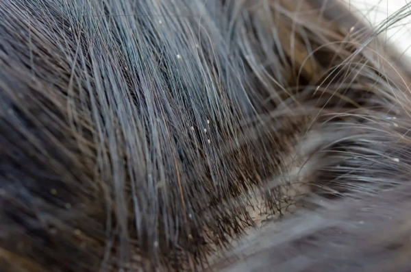 _307720352_頭發(fā)上的頭皮屑.jpg 3-tuya.jpg