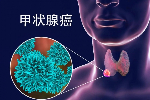 stock-image-17102502甲狀腺癌-XL(1).jpg 7-xiqu.jpg