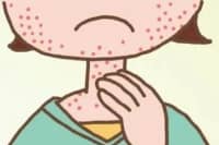 77%的嚴(yán)重過敏誘因是食物！哪些食物最容易引起過敏？