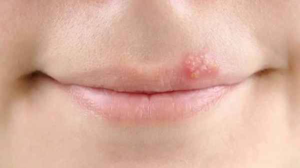 嘴上起水泡，這可不是上火！醫(yī)生：可能是單純皰疹病毒在作怪！